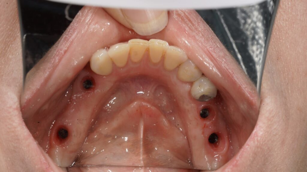 ایمپلنت دندان چیست