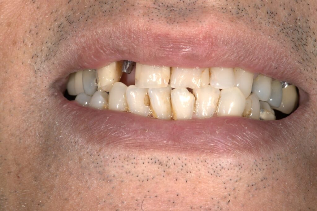 جراحی ایمپلنت دندان