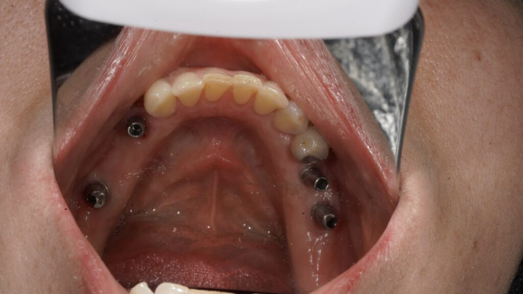 ایمپلنت دندان چیست