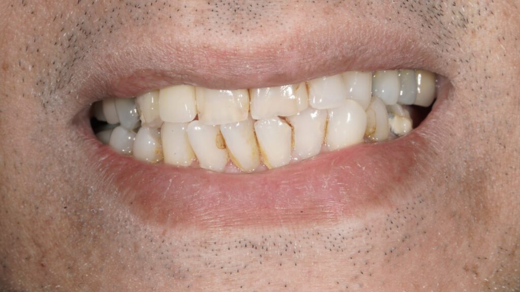 جراحی ایمپلنت دندان