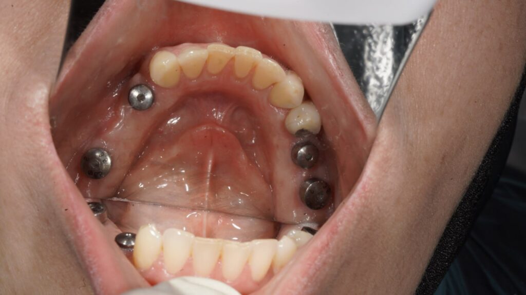 ایمپلنت دندان چیست