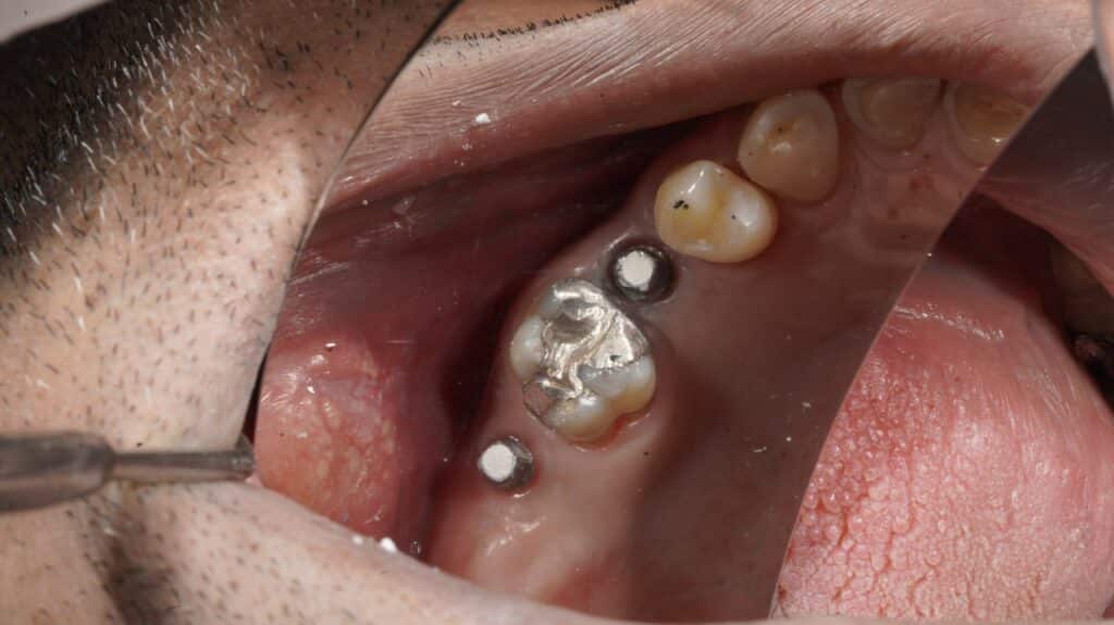 جراحی ایمپلنت دندان