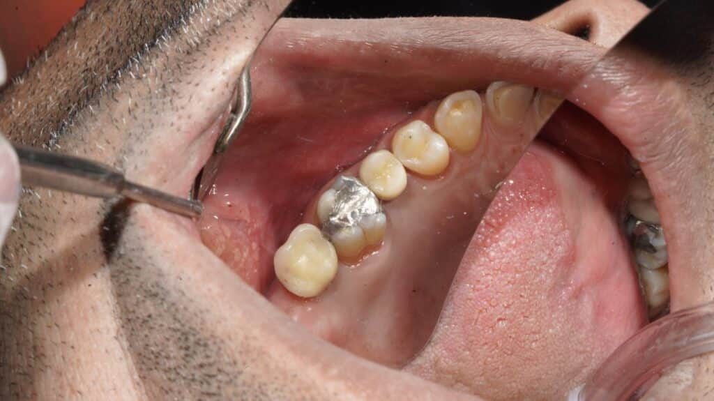 جراحی ایمپلنت دندان