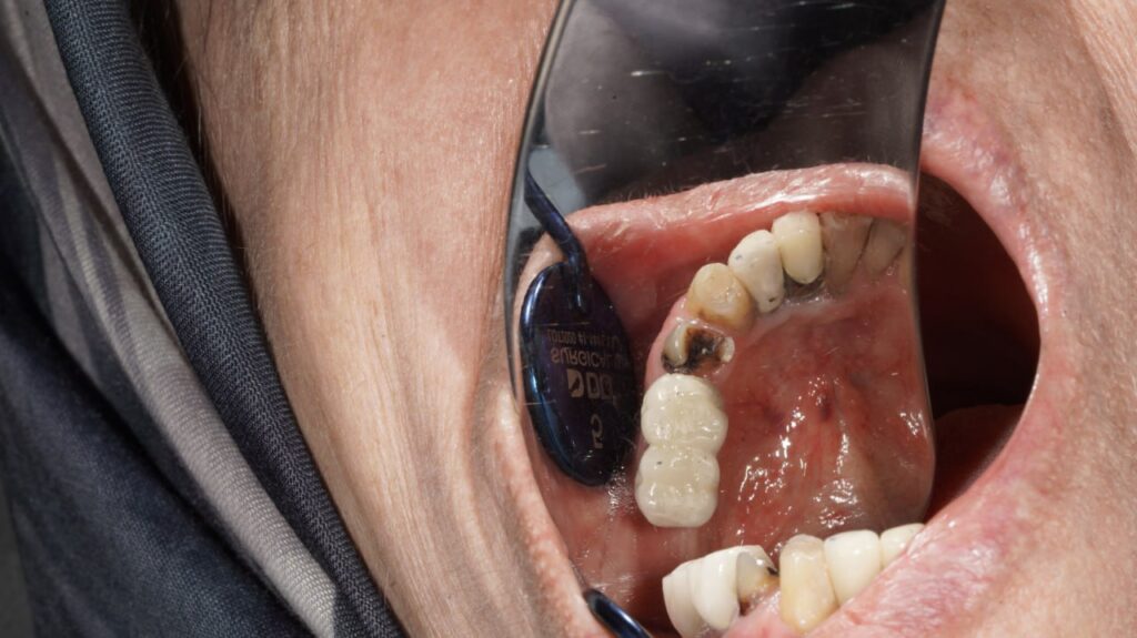 جراحی ایمپلنت دندان