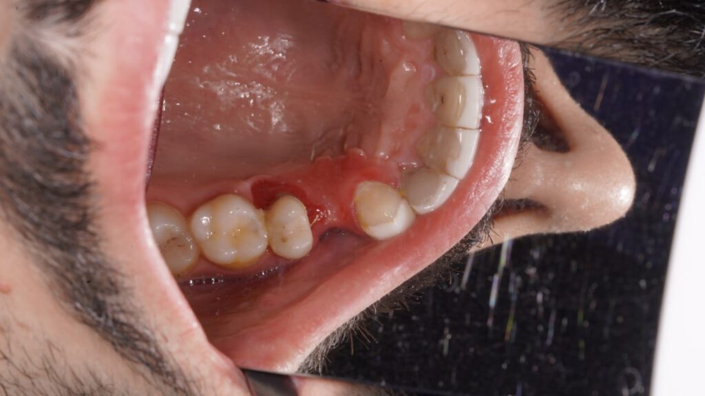 جراحی ایمپلنت دندان