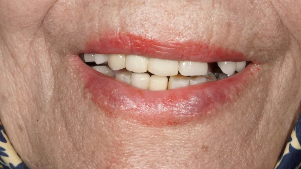 جراحی ایمپلنت دندان