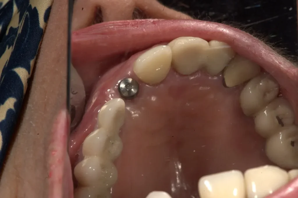 جراحی ایمپلنت دندان