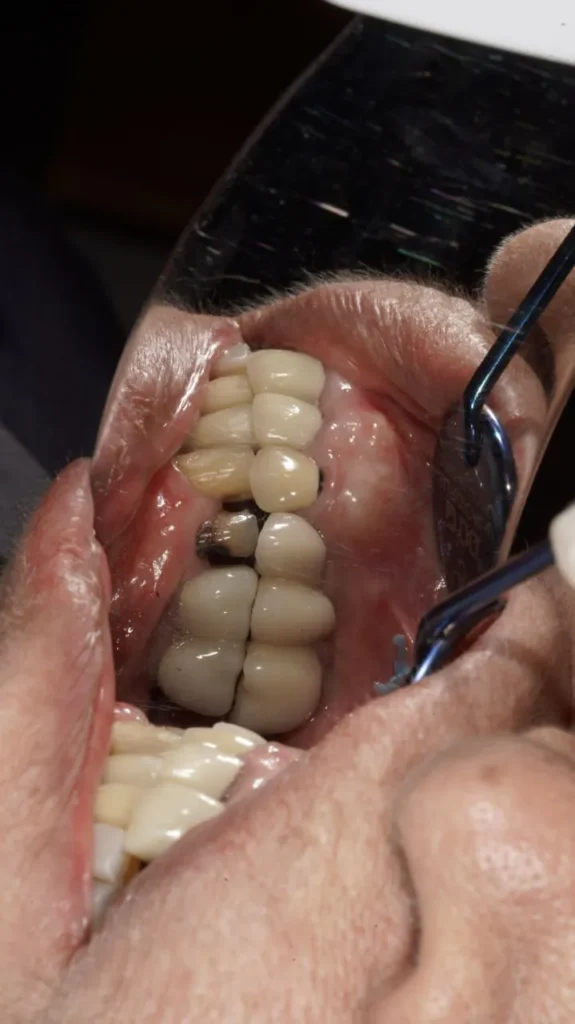 ایمپلنت فوری