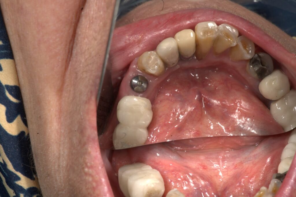 جراحی ایمپلنت دندان