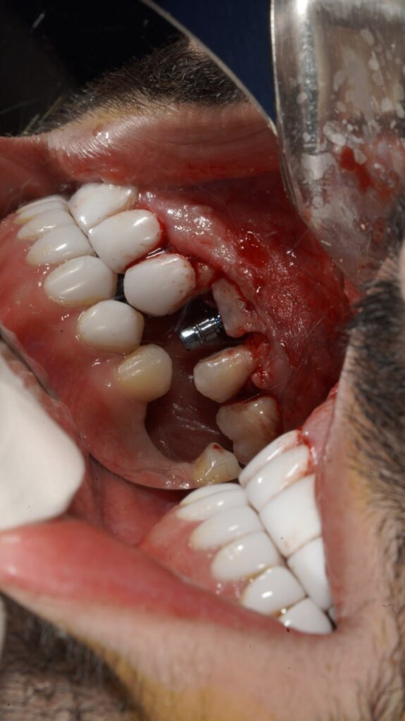 جراحی ایمپلنت دندان