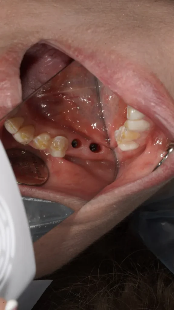 جراحی ایمپلنت دندان