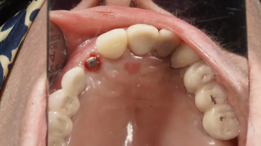 جراحی ایمپلنت دندان