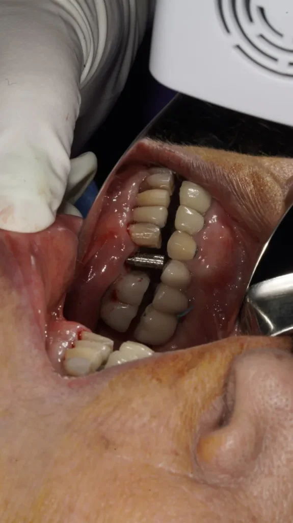 ایمپلنت فوری