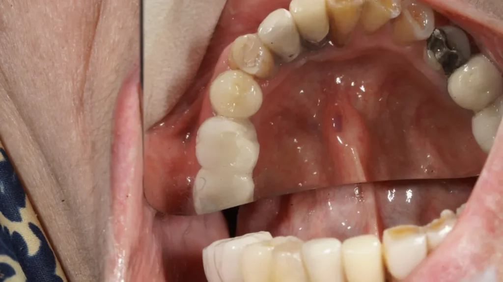 ایمپلنت فوری