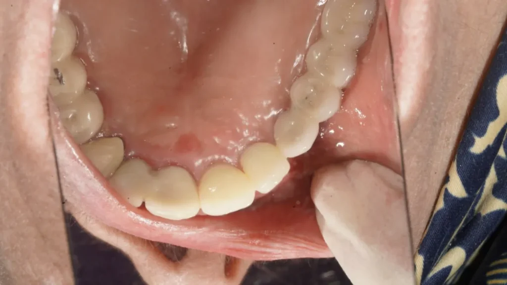 جراحی ایمپلنت دندان