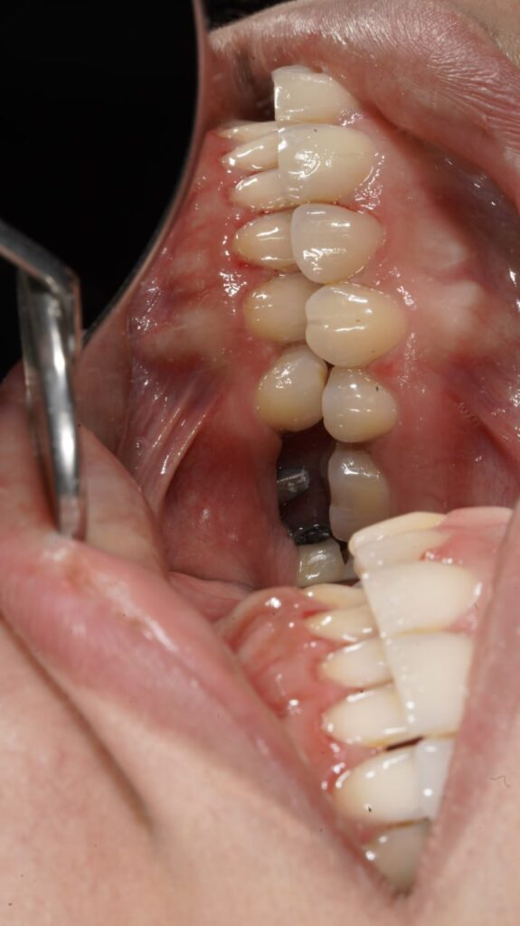 جراحی ایمپلنت دندان