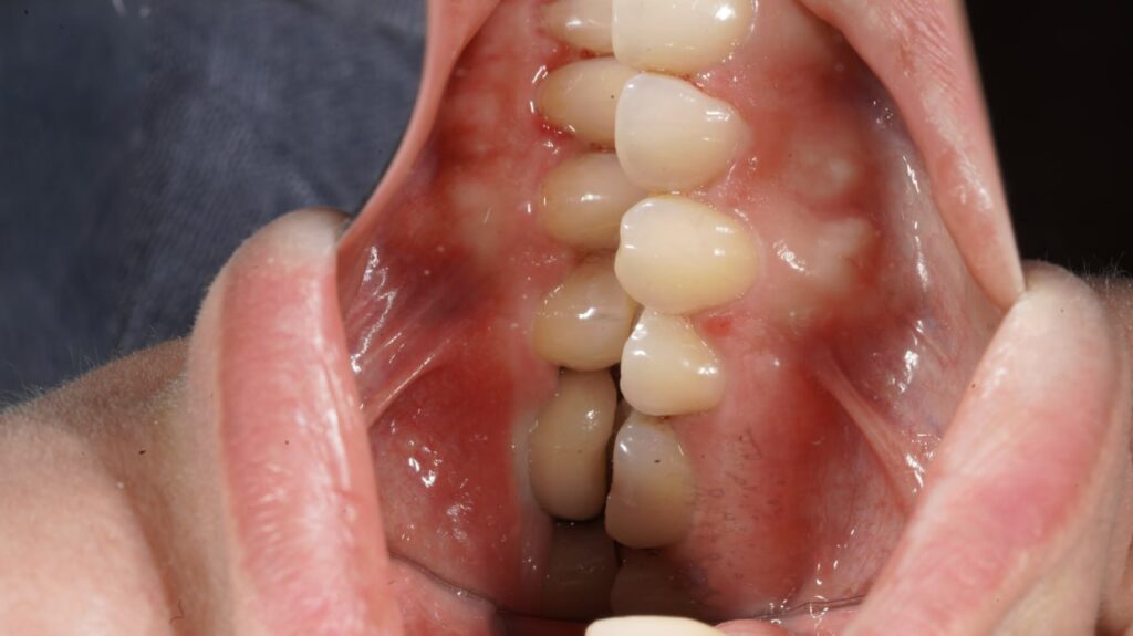 جراحی ایمپلنت دندان